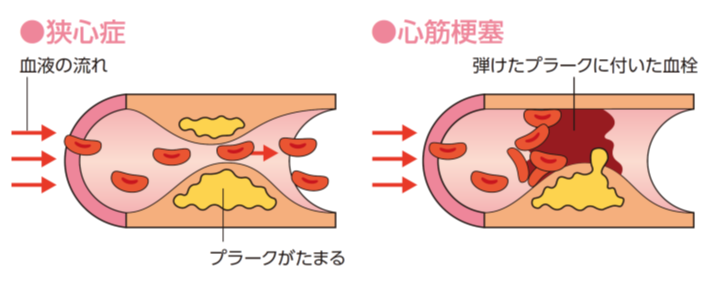 軽い 心筋 梗塞 と は