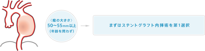 下行大動脈瘤