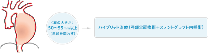 広範囲胸部大動脈瘤