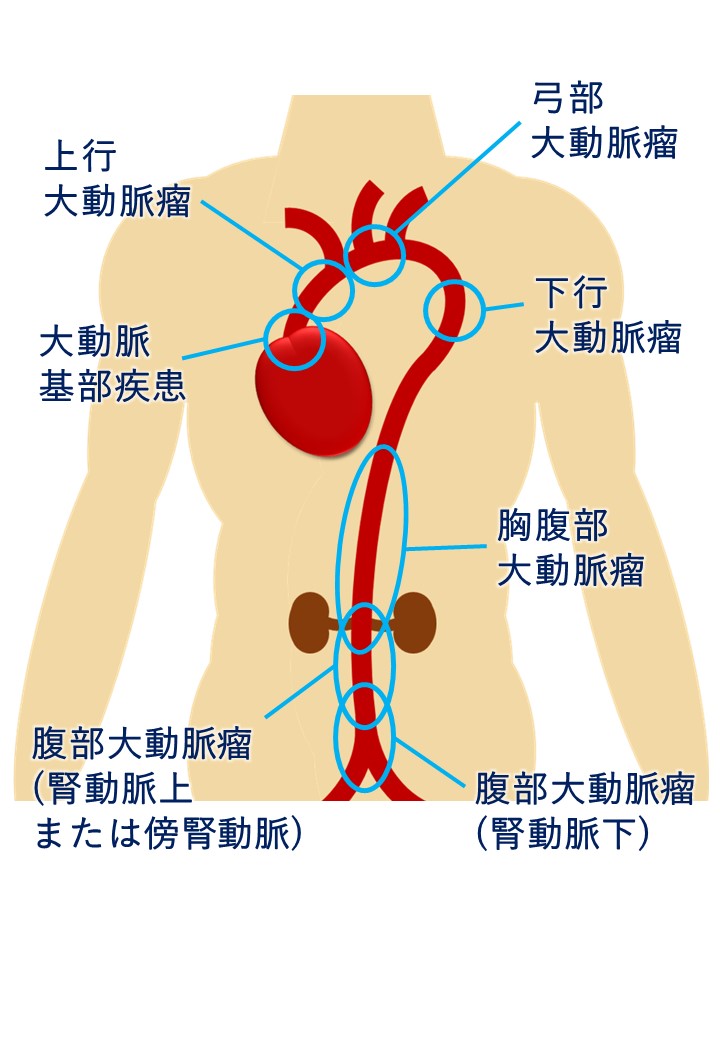 胸部 大動脈 蛇行 の 治療