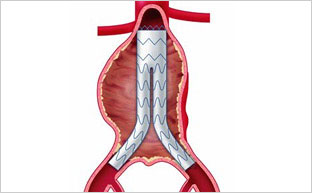 ステントグラフト治療の適応