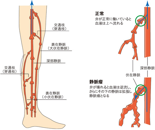 下肢静脈瘤の原因