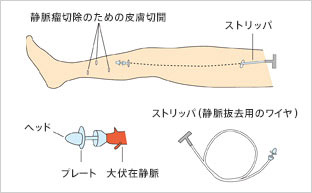 ストリッピング手術（静脈抜去術）