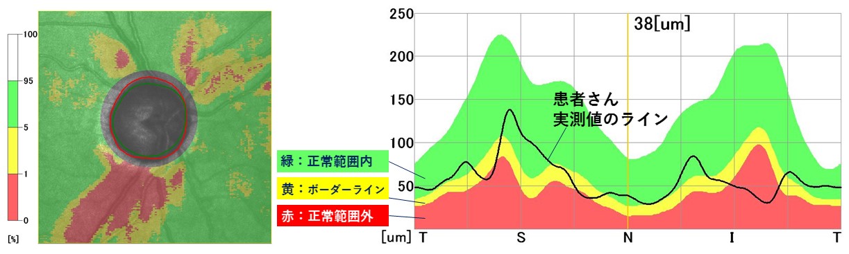 治る 緑内障