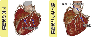 狭心症