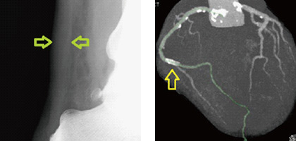 家族性高コレステロール血症患者のアキレス腱の肥厚（左）と治療を施された冠動脈（右）