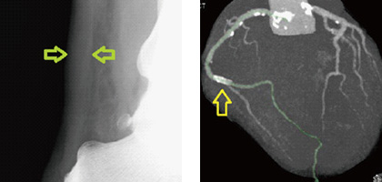 家族性高コレステロール血症患者のアキレス腱の肥厚(左)と治療を施された冠動脈(右)