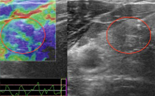 甲状腺腫瘍の硬さをみるエラストグラフィ画像