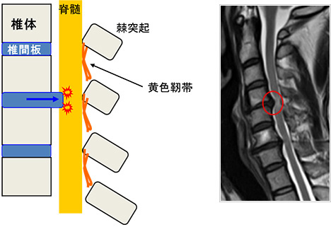 頚椎 ヘルニア 自然 治癒