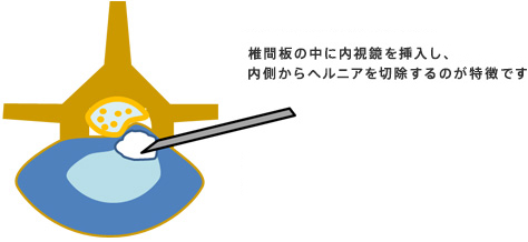 経皮的腰椎椎間板ヘルニア切除術（内視鏡での手術）