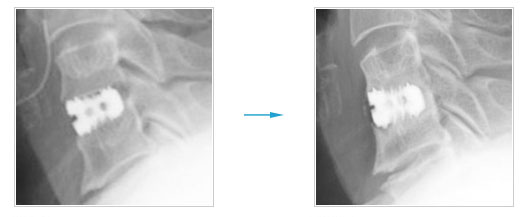 頸椎前方除圧固定術：前方からの手術