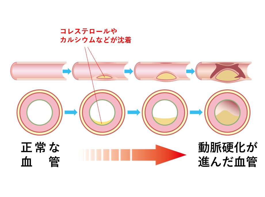 動脈 硬化 と は