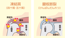 肩の痛み