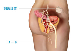 仙骨神経刺激療法（SNM）による便失禁の症状改善