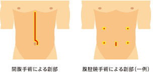 腹腔鏡手術とは？