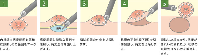 ESD（内視鏡的粘膜下層剥離術）