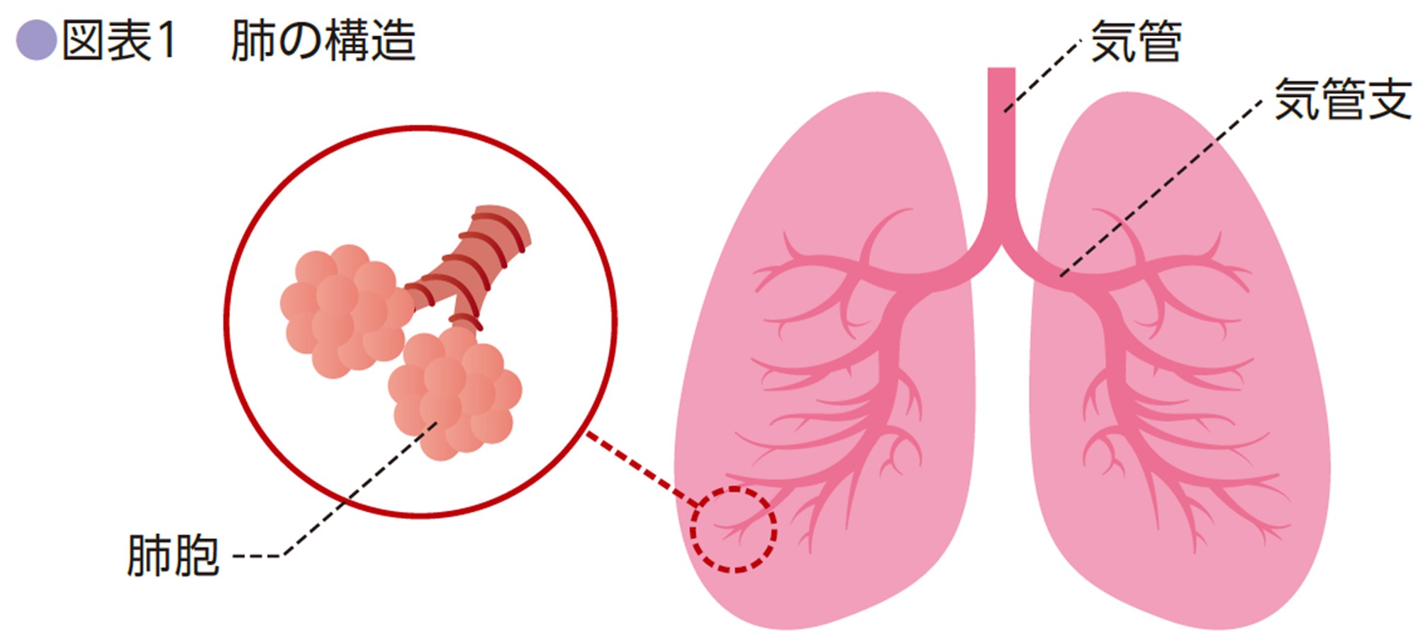 ステージ1の肺がんの症状は何ですか?